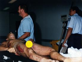 Andrew after autopsy - broken jawbone, tracheotomy wounds