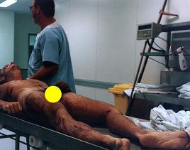 Andrew after autopsy, broken jawbone, tracheotomy wounds